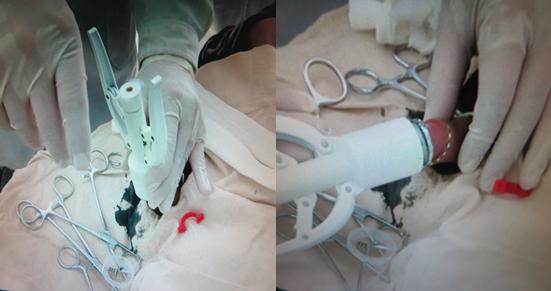 微创包皮环切术的“金标准”|丹东市中心医院